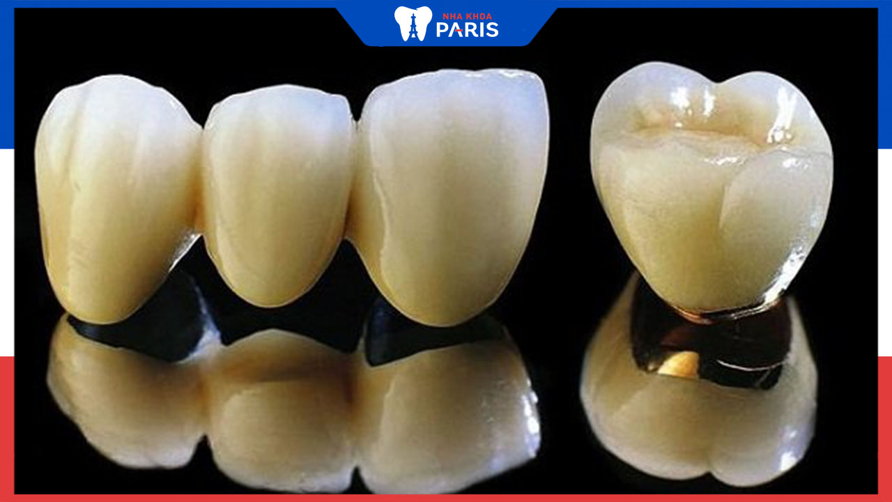 Bọc răng sứ kim loại thường là gì? Có tốt không?